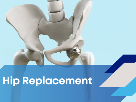 Mark Beasley Hip Replacement Resources